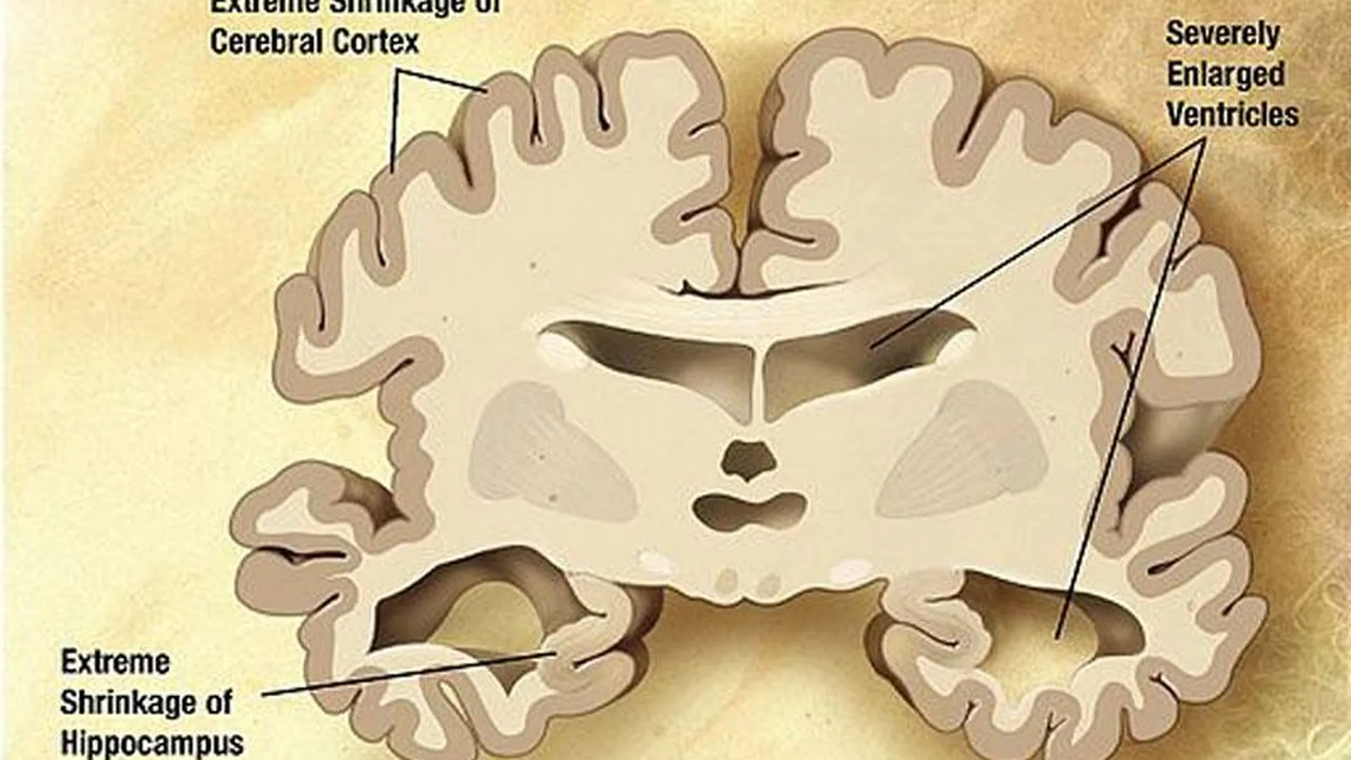 Ученые назвали первый симптом болезни Альцгеймера