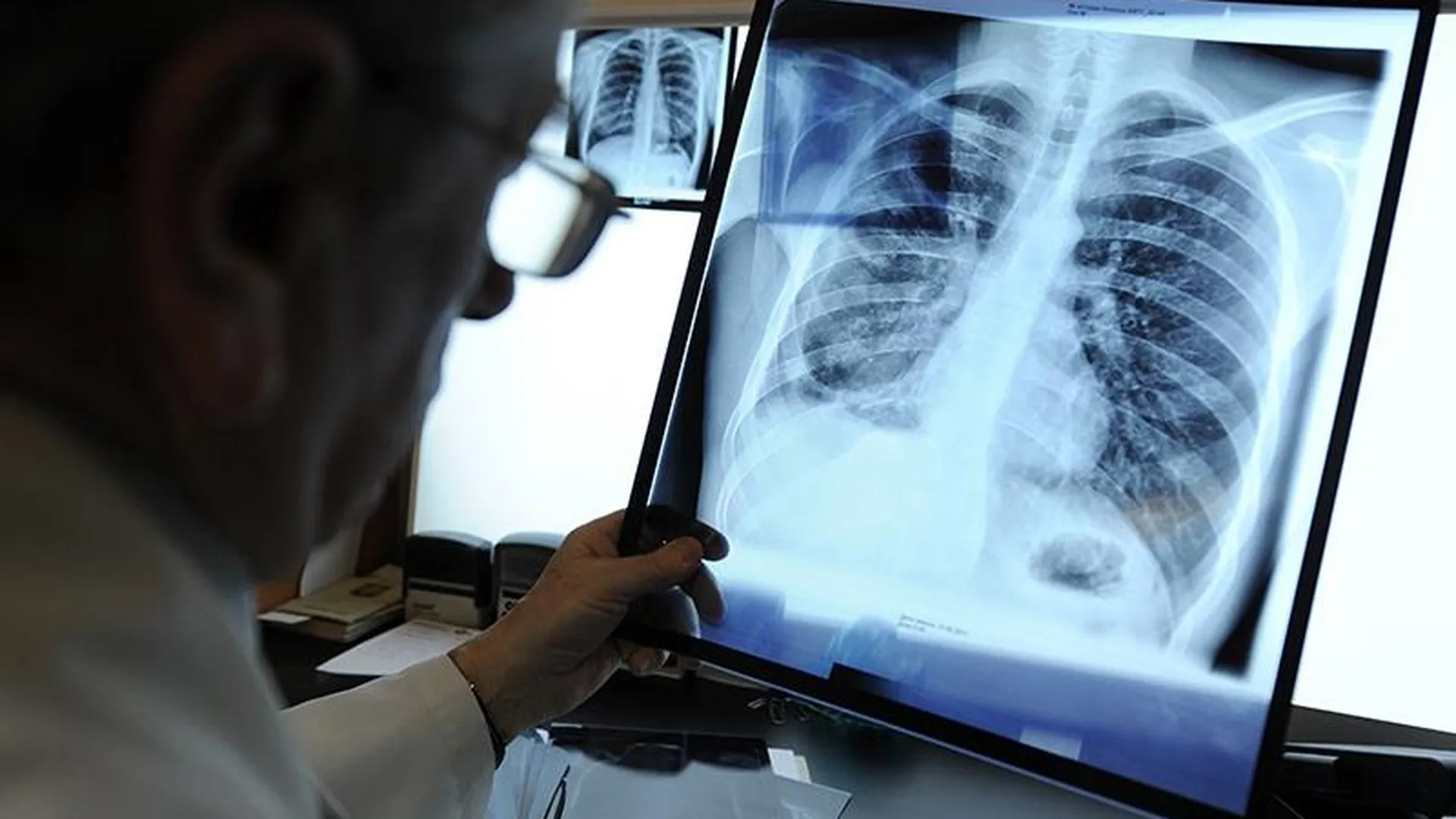 В Подмосковье снизилась смертность от туберкулеза