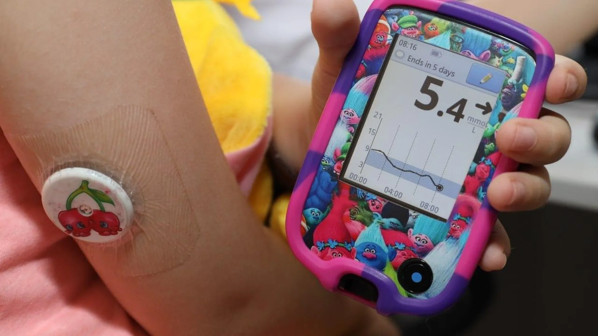 Свыше 2,5 тысячи подмосковных детей с диабетом обеспечены системами непрерывного мониторинга глюкозы