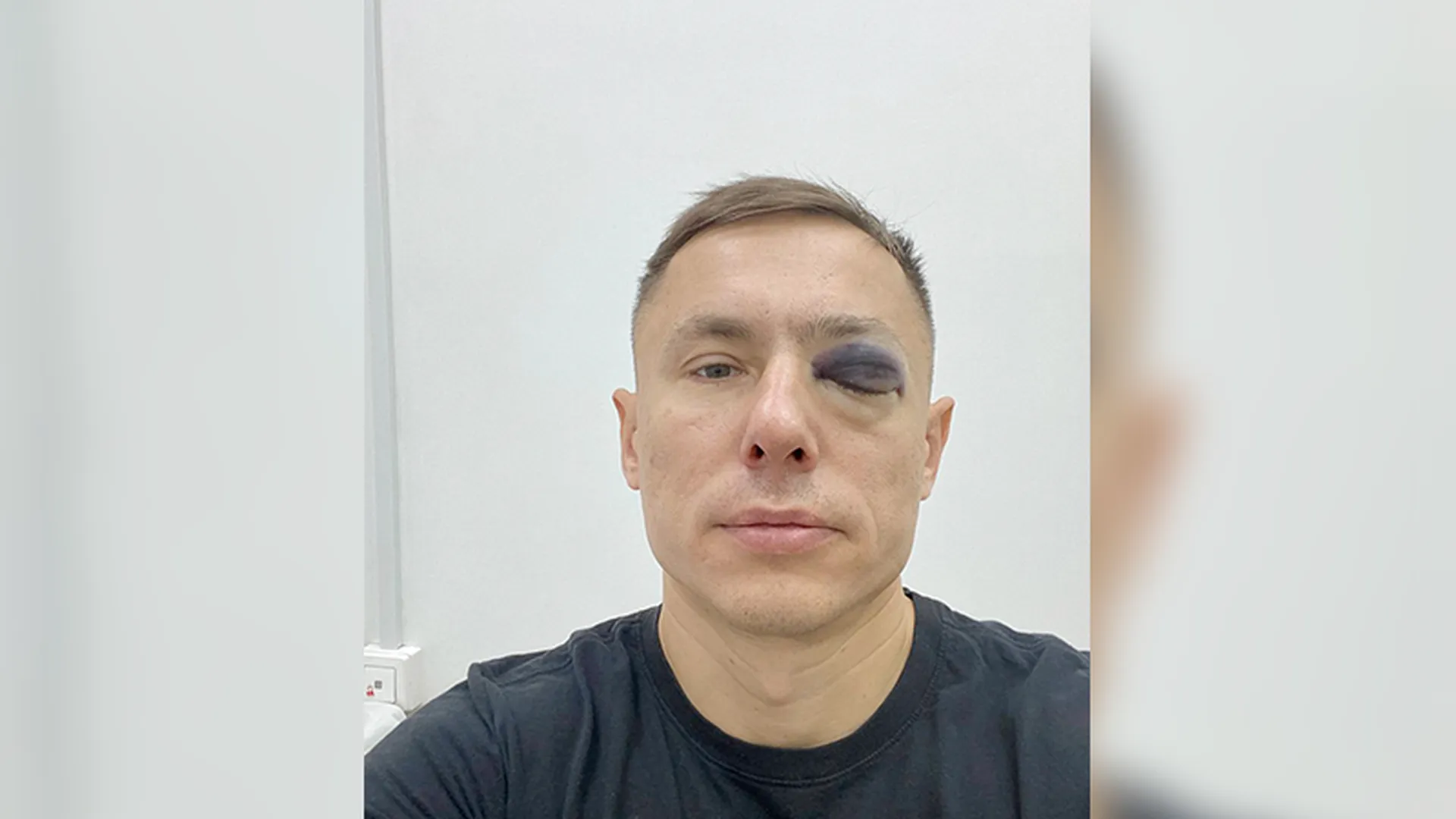 «Сломал глазницу, хлынула кровь»: уголовное дело возбудили в отношении частной московской клиники
