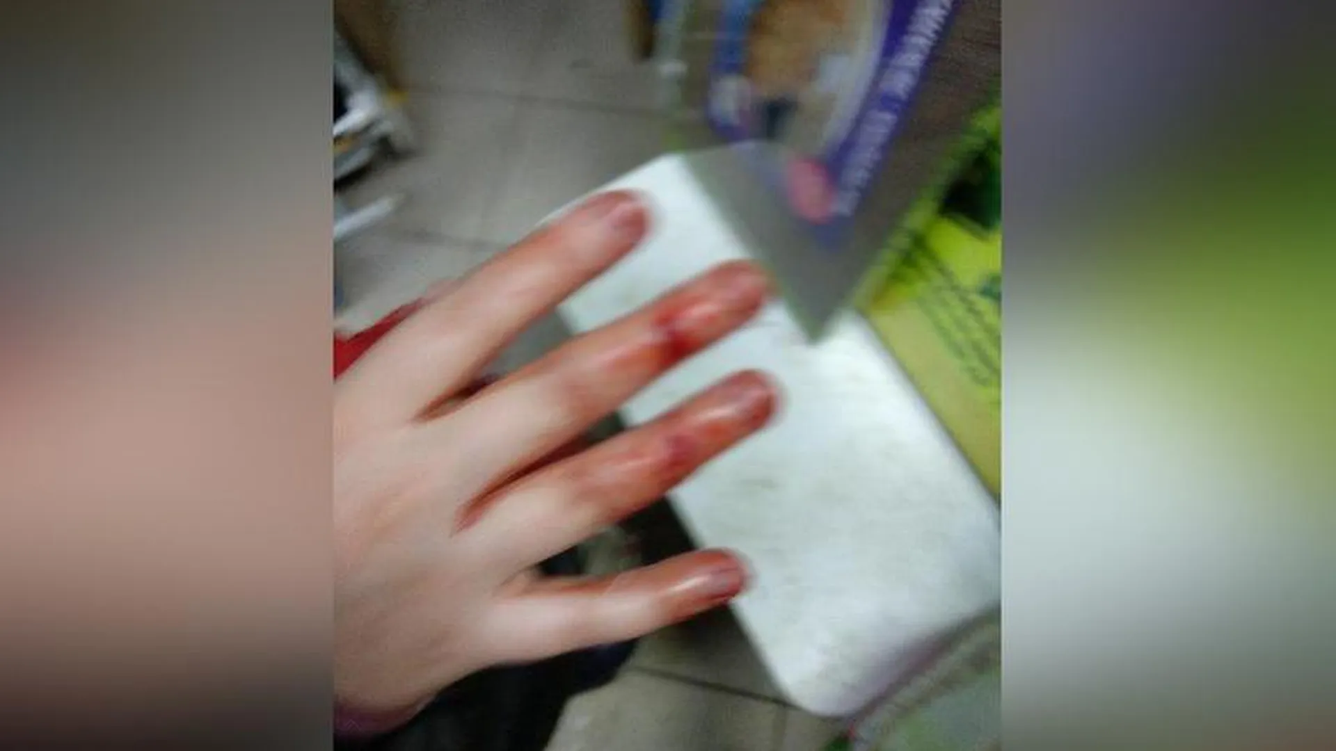 Двум детям порезали пальцы коньками на катке в Краснознаменске
