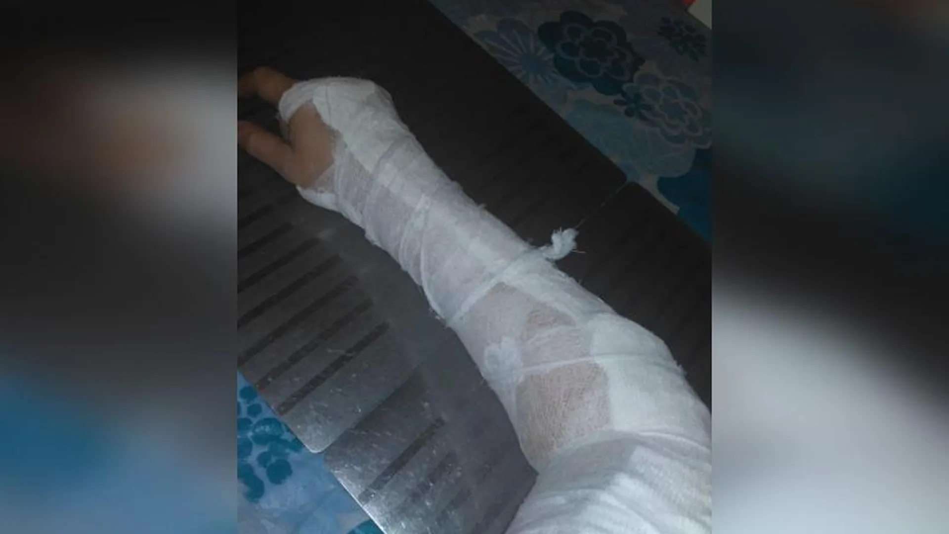 Жительница Пушкино получила перелом руки на обледеневшем тротуаре