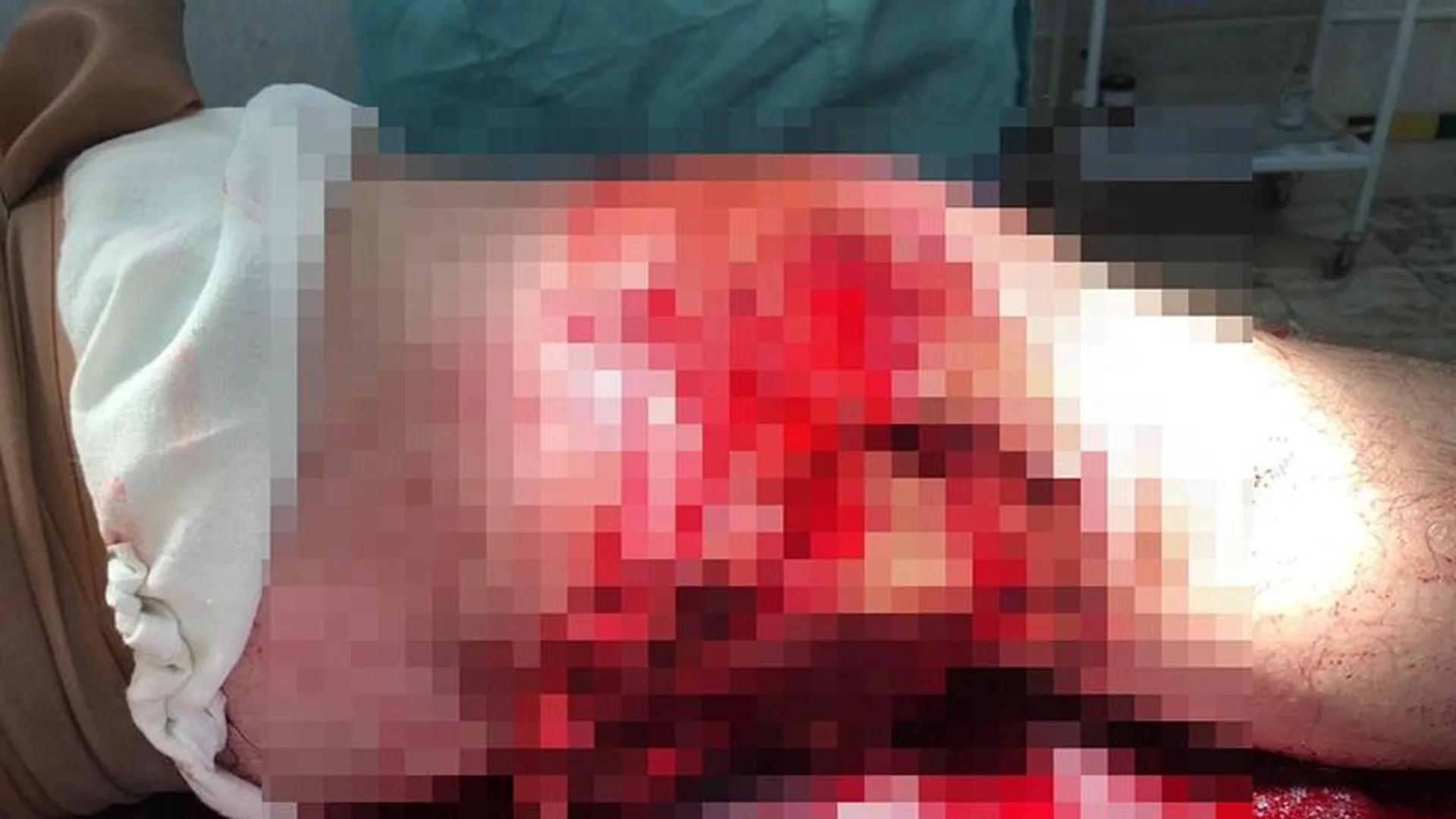 Мужчину с огнестрельными ранениями спасают врачи в Ступино