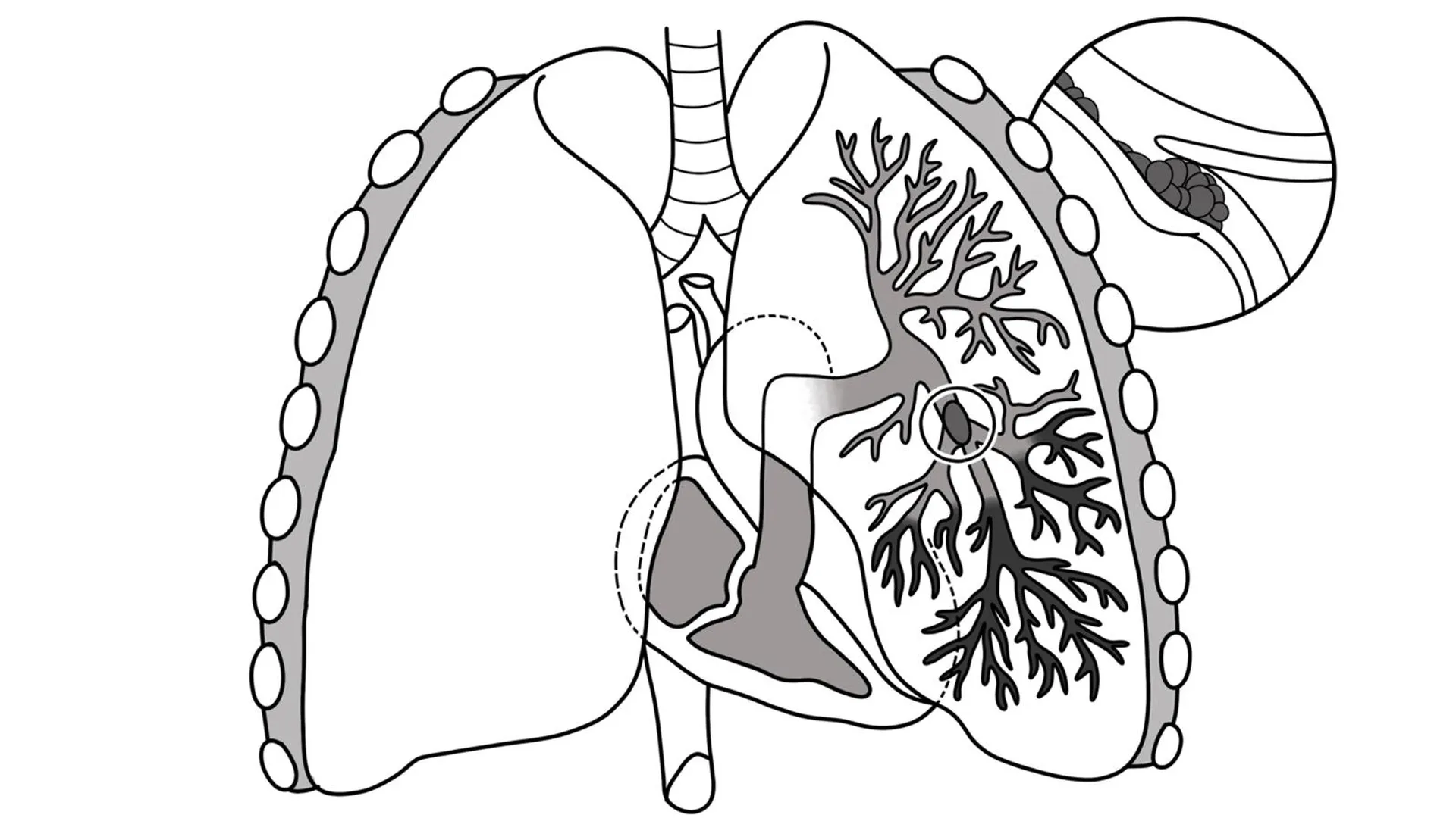 Иллюстрация тромбоэмболии легочной артерии