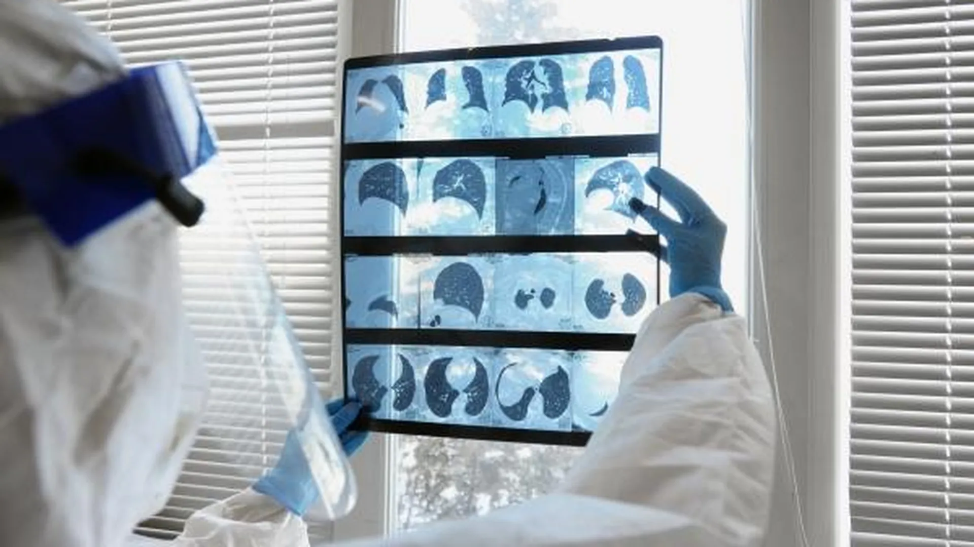 Медицинский работник изучает результат компьютерной томографии органов грудной клетки.
